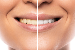 teeth whitening comparision image