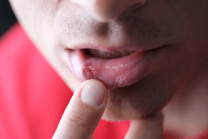 mouth sores on a person image